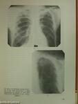 Hogyan éljen a tüdőbeteg ember?