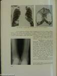 A tüdődaganatok röntgendiagnosztikája