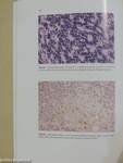 Histological Typing of Tumours of the Central Nervous System