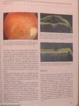 European Journal of Ophthalmology July-August 2008