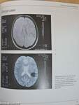 Hemangiomas and Vascular Malformations of the Head and Neck