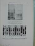 Biochemistry of Brain Tumours