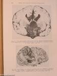 Die Hirngeschwülste in biologischer und morphologischer Darstellung