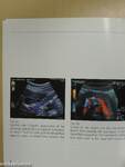 Sonography in Portal Hypertension and TIPS