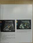 Sonography in Portal Hypertension and TIPS