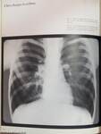 Stigmata of respiratory tract allergies