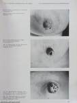 Atlas of the Diseases of the Mammary Gland/Atlas der Brustdrüsen-erkrankungen