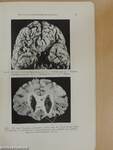 Ergebnisse vergleichender anatomisch-pathologischer und klinischer Untersuchungen an Hirngeschädigten