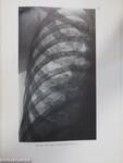 Die Lungentuberkulose im Röntgenbild