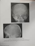 Roentgen Diagnosis of Diseases of the Skull