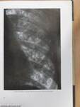 A tüdőgümőkór röntgenképe és elkülönítő kórisméje