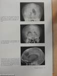 Atlas der Pneumoenzephalographie bei Hirntumoren