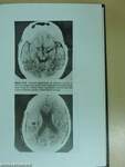 A cerebrovascularis kórképek CT diagnosztikája