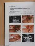 A gyakorló fogorvos implantológiája
