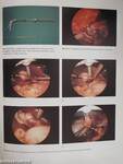 Laparoscopic Biliary Surgery