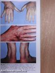 Lipids and Lipid Disorders