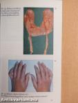 Hypertonia