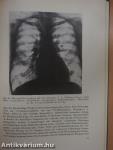 Cor pulmonale chronicum