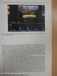 Echokardiographische Diagnostik bei koronarer Herzkrankheit