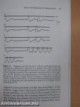 Mechanisms of Arrhythmias