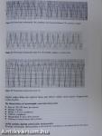 Cardiac Arrhythmias