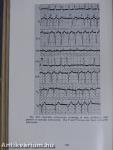 Clinical Unipolar Electrocardiography