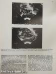 Two-dimensional real-time ultrasonic imaging of the heart