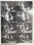 Two-dimensional real-time ultrasonic imaging of the heart