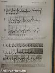 Cardiac Arrhythmias