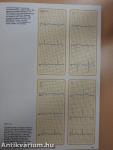 Understanding the Electrocardiogram 2.