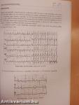 Acut myocardialis infarctus és instabil angina az EKG tükrében