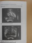 Benignus prostatahyperplasia
