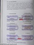 Atherosclerosis