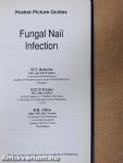 Fungal Nail Infection