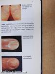 Fungal Nail Infection