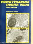 Polycythaemia rubra vera klinikuma, pathologiája és korszerű kezelése