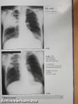 A tüdő megbetegedéseinek röntgenatlasza