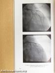 Angina pectoris