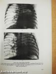 A tüdő röntgendiagnosztikája