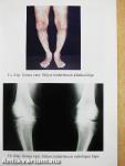 Arthrosis a mindennapi gyakorlatban