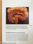 Inflammatory Bowel Disease