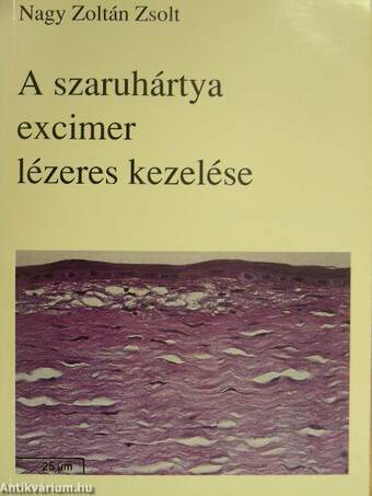 A szaruhártya excimer lézeres kezelése