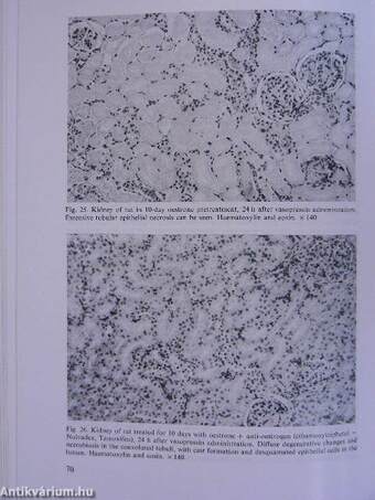 Renal Cortical Necrosis