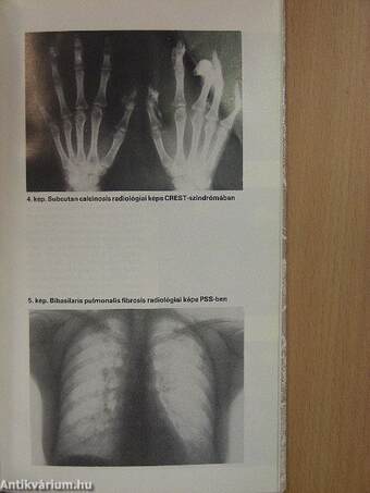 Fibrosissal járó kórképek