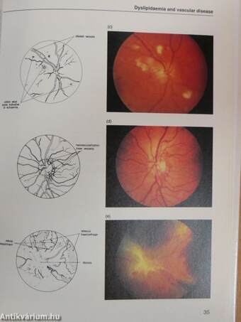 Lipids, Diabetes and Vascular Disease