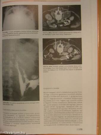 Pulmonális és extrapulmonális tuberkulózis