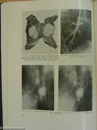 A tüdődaganatok röntgendiagnosztikája