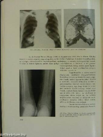 A tüdődaganatok röntgendiagnosztikája