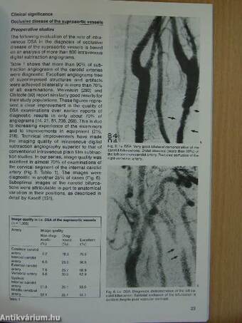 Digital Subtraction Angiography in Outpatients