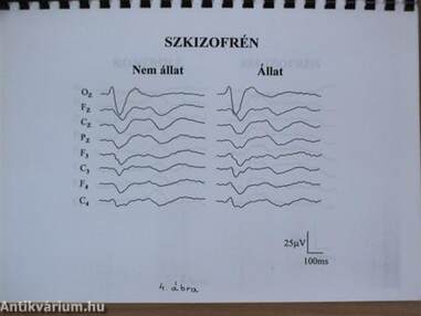 Vizuális eseményfüggő potenciálok szemantikus komponenseinek vizsgálata szkizofréniában